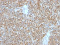 FFPE human melanoma sections stained with 100 ul anti-Bcl-2 (clone BCL2/782 + BCL2/796) at 1:50. HIER epitope retrieval prior to staining was performed in 10mM Tris 1mM EDTA, pH 9.0.